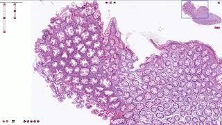 Hyperplastic Polyp  Colon  Histopathology [upl. by Lenes]