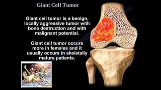 Giant Cell Tumor  Everything You Need To Know  Dr Nabil Ebraheim [upl. by Annairt420]