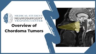 Overview of Chordoma Tumors [upl. by Meeki120]