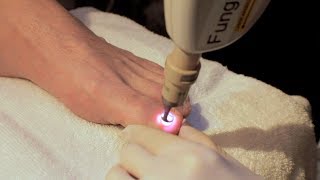 Laser Treatment of Toe Nail Fungus [upl. by Lister]