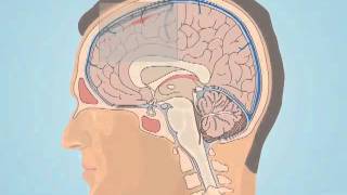 Understanding Subarachnoid Hemorrhage [upl. by Ariam]