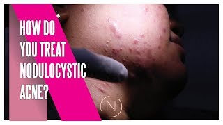 How Do You Treat Nodulocystic Acne  Houston Dermatology [upl. by Anica742]