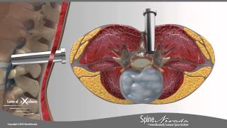 Lumbar Microdiscectomy  Spine Center Northern Nevada Northern California  Spine Surgery [upl. by Brink]