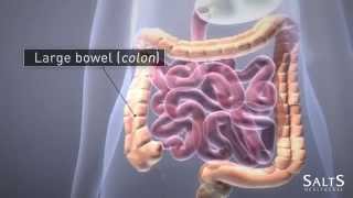 What is an Ileostomy [upl. by Pall]