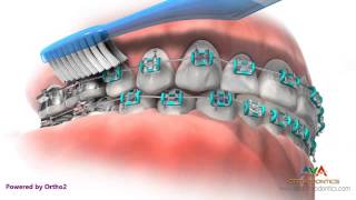 Life with Braces  Brushing amp Flossing [upl. by Harcourt258]