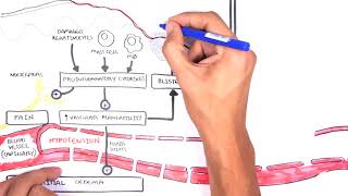 Burns DETAILED Overview  Types Pathophysiology TBSA [upl. by Auhsuoj710]