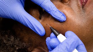 Skin Tags Removal with Electrolysis [upl. by Nedrah]