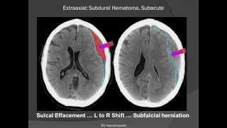 Subdural Hematoma SDH [upl. by Talie]