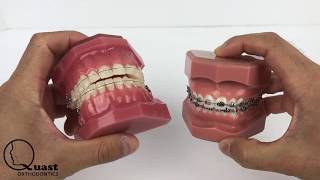 Ceramic Braces vs Metal Braces [upl. by Otrebmal]