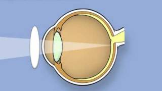 Retinoscopy of the eye Ophthalmology [upl. by Nilyram]