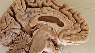 Third Ventricle  neuroanatomy  boundaries  recesses [upl. by Dovev]