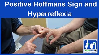 Positive Hoffmans Sign and Hyperreflexia [upl. by Tocci]