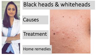 How to remove blackheads amp whiteheads Causes Treatment  Home remedies dermatologist [upl. by Nicholas]