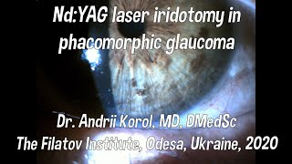 NdYAG laser iridotomy in phacomorphic glaucoma [upl. by Inajar]