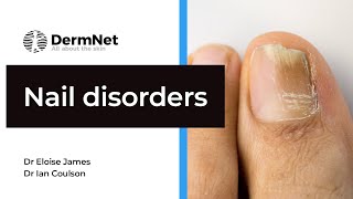 Nails and Nail Disorders [upl. by Aissela]