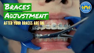 How Do Braces Straighten Teeth [upl. by Rivy]