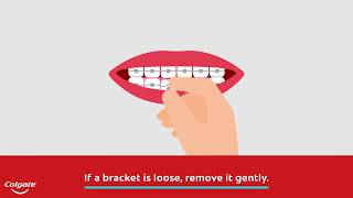 How to Fix a Broken Braces Bracket [upl. by Rebecca656]