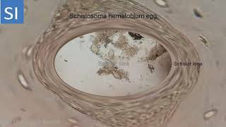 Schistosoma hematobium egg in urine [upl. by Llecram]