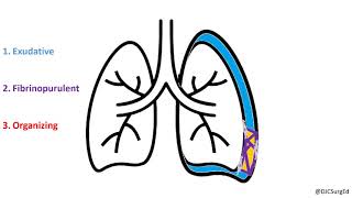 Empyema and Pleural Effusions [upl. by Ailecara979]