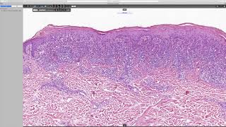 Lichenoid keratosis Phillip H McKee Antonina Kalmykova amp CSD Health Care [upl. by Nylireg]