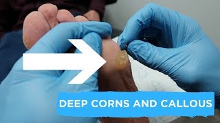 DEEP CORNS AND CALLOUS  FULL TREATMENT [upl. by Iams268]