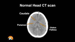 CT Scan of the Head A Radiologists Approach [upl. by Yerocaj]