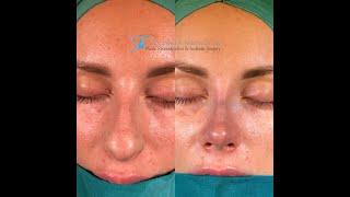 Nose Tip Surgery  Closed Rhinoplasty [upl. by Alcot]