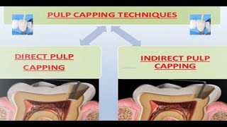 PULP CAPPING Procedure and pulp capping a case report [upl. by Lionel244]