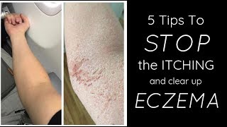 Eczema Symptoms Causes and Treatment  Doctors on TV [upl. by Maclean963]