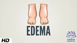 Edema Causes Signs and Symptoms Diagnosis and Treatment [upl. by Lovell187]