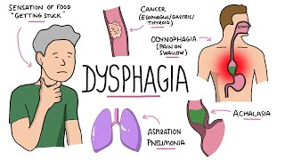 Dysphagia  Oropharyngeal amp Esophageal Dysphagia CausesDifferential Diagnosis Signs Treatment [upl. by Aspasia]