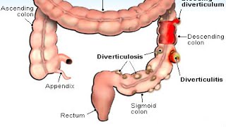 Diverticulitis [upl. by Hertzog586]