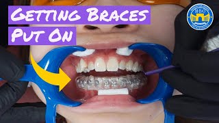 Process of Getting Braces [upl. by Freida839]