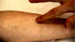 How to take a TB Skin Test [upl. by Wyon464]