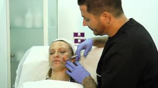 Tratamiento facial con Sculptra [upl. by Anitsua]