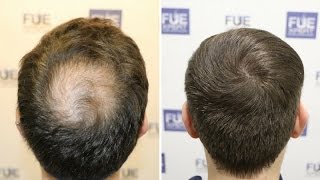 FUE Hair Transplant 1850 FUE Grafts in CrownVertex by Dr Couto  FUEXPERT CLINIC  Madrid Spain [upl. by Pretrice582]