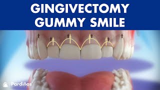 Gingivectomy  Treatment for gummy smile © [upl. by Calvano]