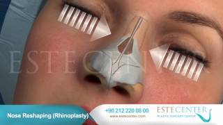 Nose Reshaping Rhinoplasty  Estecenter [upl. by Noiramed]