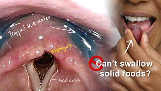 Cricopharyngeal Dysfunction Difficulty Swallowing Especially Solid Foods [upl. by Arrait]