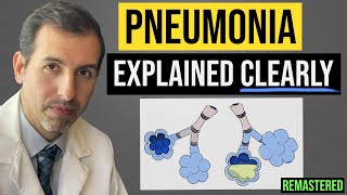 Pneumonia Explained Symptoms Diagnosis Labs Treatment [upl. by Maroney]