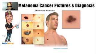 Spotting Melanoma Cancer and Symptoms with Pictures [upl. by Nnuahs439]