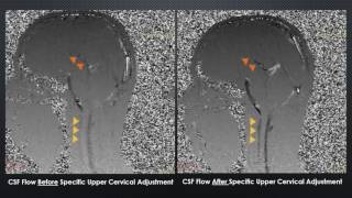 CSF Cerebrospinal fluid examination Part 2 [upl. by Nie]