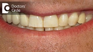 Can one whiten the teeth if having Dental Fluorosis  Dr Aniruddha KB [upl. by Noled363]