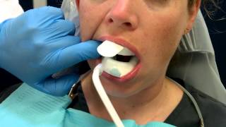 Fluoride Tray Placement and Procedures [upl. by Notsle238]