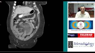 Tuberculous lymphadenitiscervical lymphadenitis Treatment diagnosis and investigations [upl. by Romney]