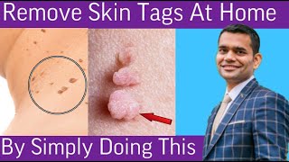 Remove Skin Tags  Home Remedies To Remove Skin Tags  Dr Vivek Joshi [upl. by Tirb]