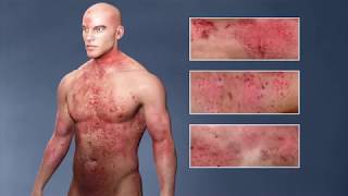 8 Ways to Get Rid of Eczema [upl. by Tnirb]