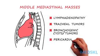 General Surgery – Mediastinal Mass By Rishindra M Reddy MD [upl. by Aridan]