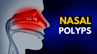 NASAL POLYPS Causes SIgns and Symptoms Diagnosis and Treatment [upl. by Assirolc479]