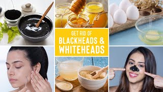 Easy Ways To Remove Blackheads And Whiteheads At Home [upl. by Cowen512]